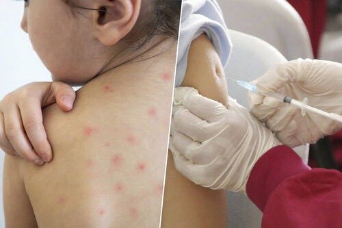 Quintana Roo cerca de los 200 casos de sarampión