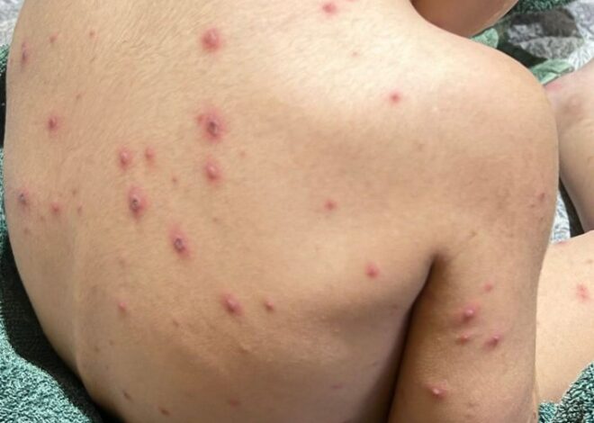 Aumentan casos de varicela y Mpox en Quintana Roo durante 2026