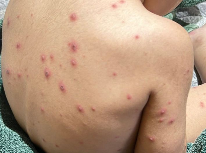 Aumentan casos de varicela y Mpox en Quintana Roo durante 2026