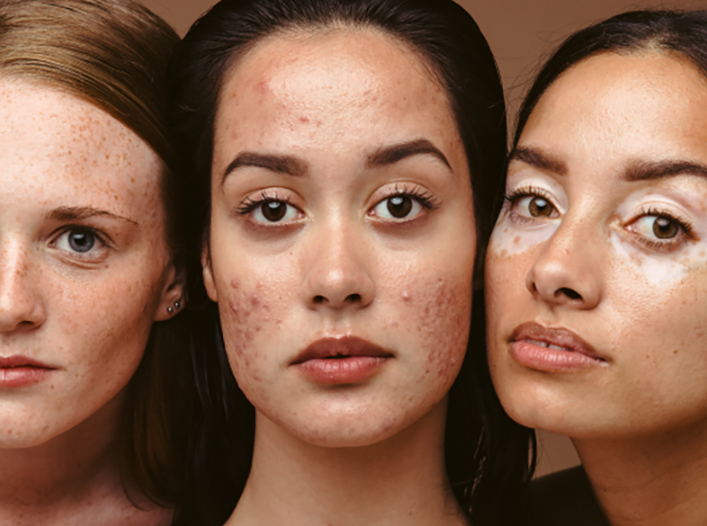 ¿El acné hormonal empeora con lo que comes? Esto dice la ciencia